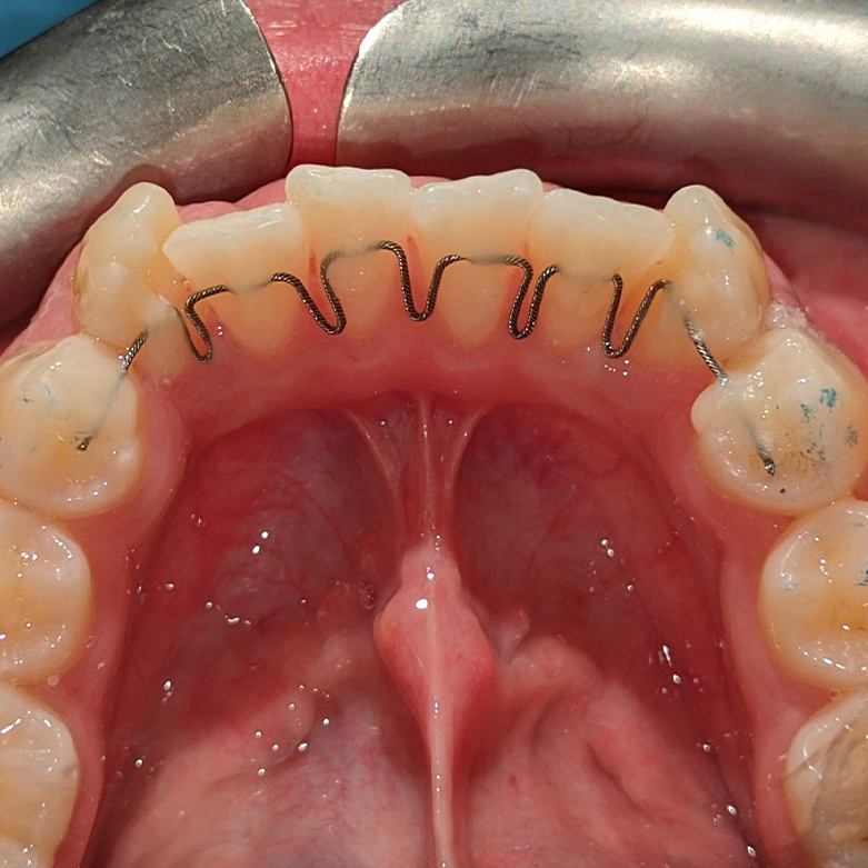 ortodonzia fissa senza attacchi